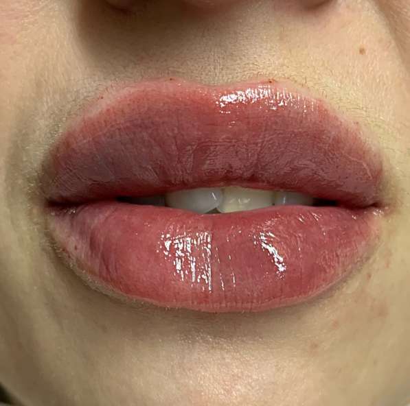 Увеличение губ в Мытищи фото 10