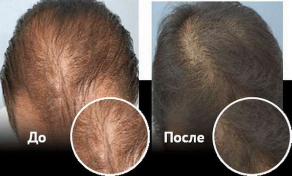 Спрей для восстановления и роста волос Ultra Hair Spray Syst в Москве фото 8