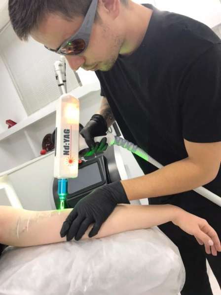 Удалить тату в Москве