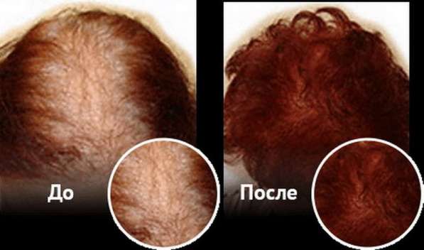 Спрей для восстановления и роста волос Ultra Hair Spray Syst в Москве фото 9