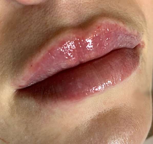 Увеличение губ в Мытищи фото 8