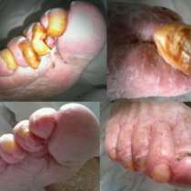 Медицинский аппаратный педикюр.Педикюр пожилым людям,лежачим больным, в Санкт-Петербурге